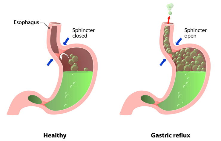 Treat GERD Symptoms Like Heartburn With NWMC Heartburn Center