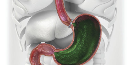Magnetic Sphincter Magnetic sphincter